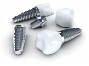 Three Dental implant (done in 3d)