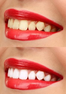Women smile with teeth: whitening - bleaching treatment , before and after